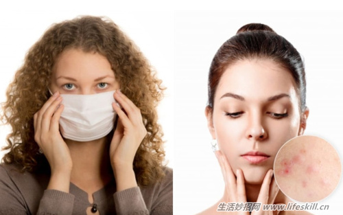 长时间戴口罩,如何避免生暗疮?