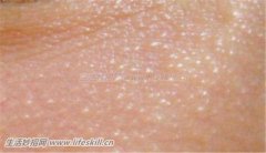 眼睛周围这些疙瘩是什么？如何消除？